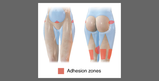 紅色部位是黏著區, 在大腿抽脂屬於不能抽脂的部位